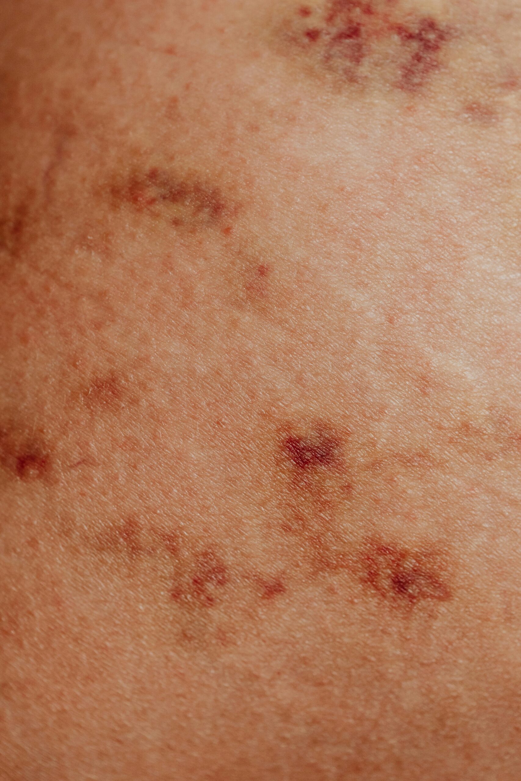 Magnétiseur pour eczéma, verrues et problèmes de peau