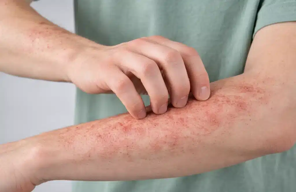 magnetiseur eczéma et problemes de peau