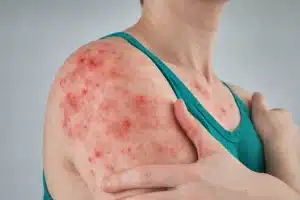 Comment le magnétisme agit sur les problèmes de peau magnetisme eczema
